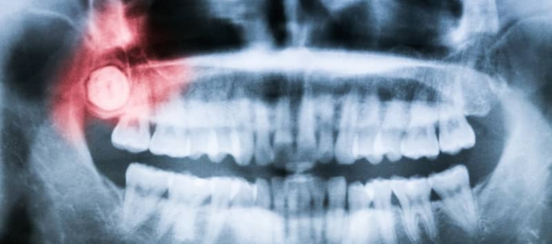 ¿Siente dolor constate en sus dientes? ES posible que necesite una cirugía de cordales